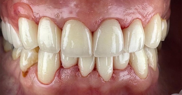 Close-up of human teeth showing moderate malocclusion with overlapping and protruding teeth; slight discoloration near the lower left canine; gums appear healthy.