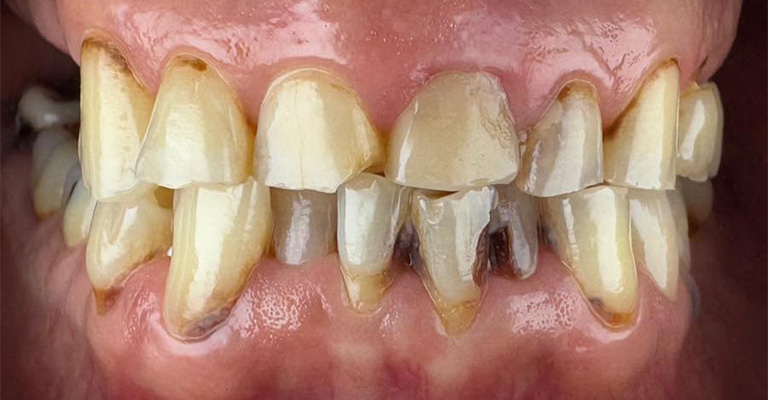 Close-up of a person’s teeth showing significant misalignment, discoloration, and wear; several teeth overlap while others have visible gaps; gums appear inflamed, suggesting possible periodontal disease and poor oral hygiene.