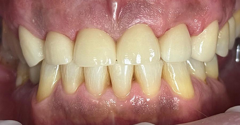 Close-up of a person’s mouth showing slightly misaligned teeth with upper front teeth overlapping lower front teeth; gums appear healthy and lips are parted.