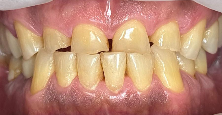 Close-up of a person’s mouth showing yellowish teeth with visible gaps between several upper and lower teeth; gums appear healthy and lips are slightly parted.