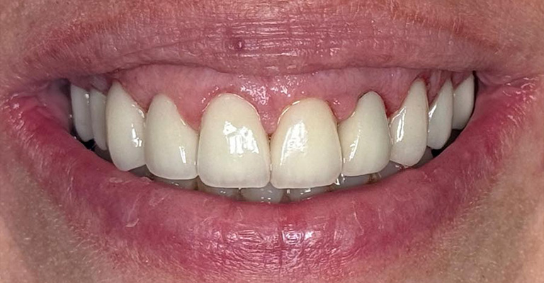 Close-up of a person’s mouth showing clean, well-aligned teeth with a visible gap between the upper front teeth; gums appear healthy and lips are slightly parted.
