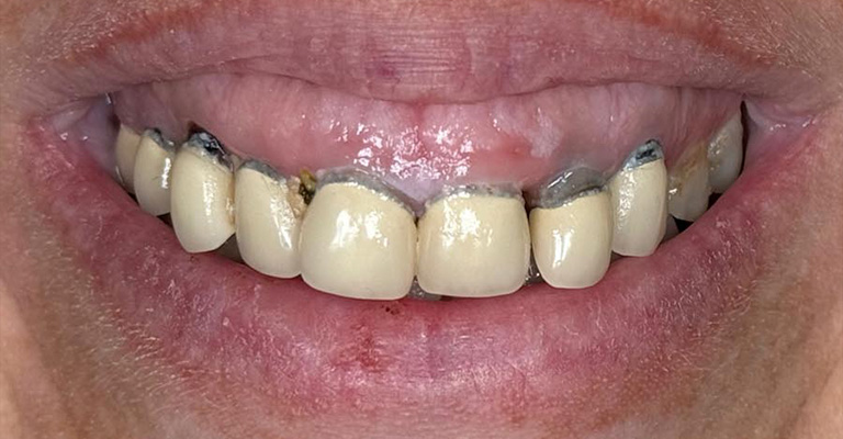 Close-up of a person’s mouth showing dental crowns with visible discoloration and decay near the gum line and between teeth; gums appear inflamed, indicating possible gum disease and poor oral hygiene.