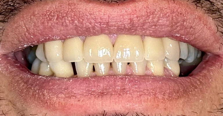 Close-up of a person’s mouth with parted lips showing slightly misaligned upper and lower teeth; upper front teeth have visible gaps and yellowish discoloration; gums and lips are also visible.