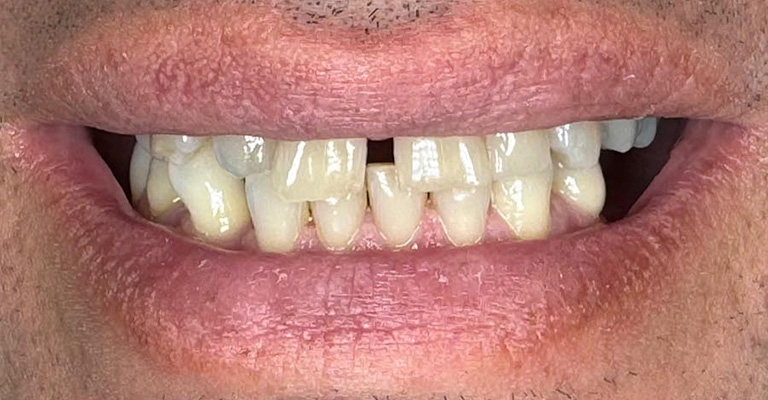 Close-up of a person’s mouth showing slightly misaligned upper and lower teeth with a yellowish tint; lips and gums are visible.