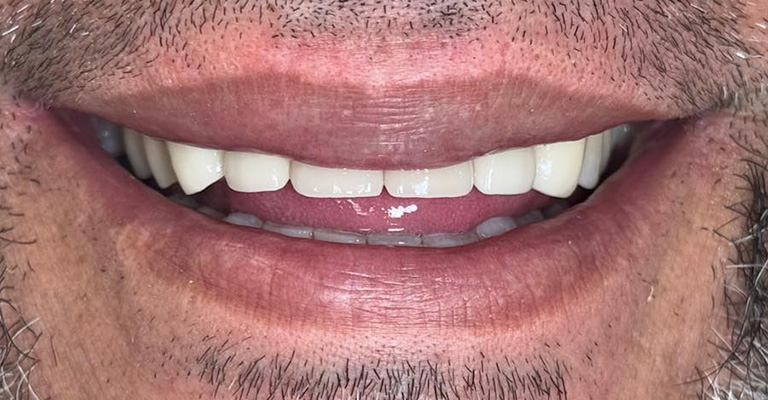 This close-up image displays clean, well-aligned upper and lower front teeth with natural enamel and no visible restorations. The gum tissue appears healthy—pink, symmetrical, and without signs of recession or inflammation.