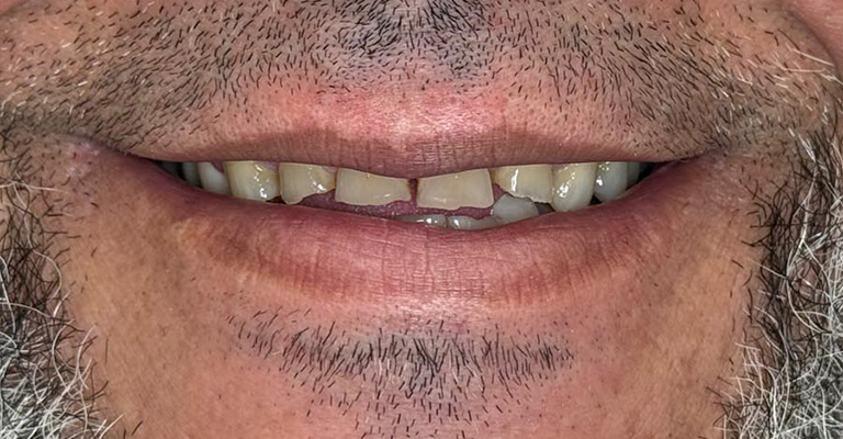 This close-up image shows upper and lower front teeth with notable misalignment and surface discoloration. The enamel appears slightly worn, and the teeth are asymmetrical in both spacing and shape.