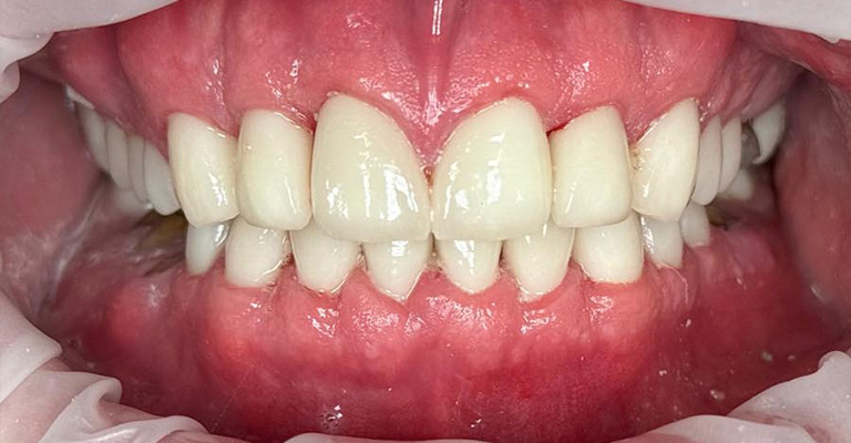 This image displays relatively healthy upper and lower front teeth with no obvious decay, restorations, or severe staining. The enamel is generally intact, although there’s subtle yellowing that could suggest mild extrinsic staining.