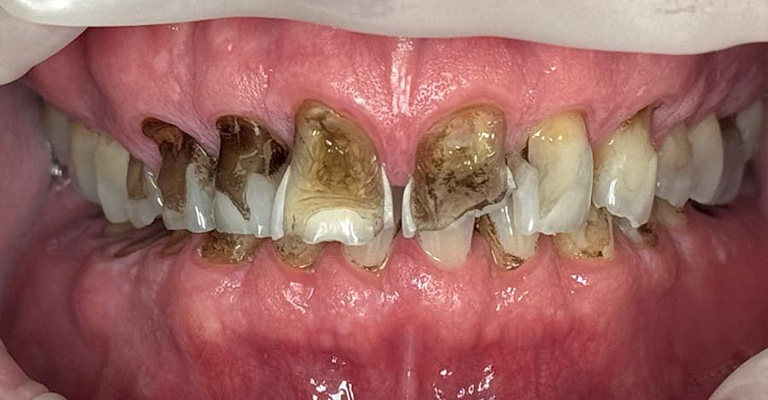 This close-up image reveals extensive dental decay affecting multiple upper and lower teeth. Brown and black staining dominate the enamel, especially near the gum line, with noticeable structural erosion on several teeth.