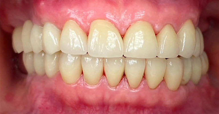 This image shows clean, well-aligned upper and lower front teeth with no visible decay, staining, or restorations. The enamel appears intact and evenly colored, and the gums are pink and healthy, with no signs of inflammation or recession.