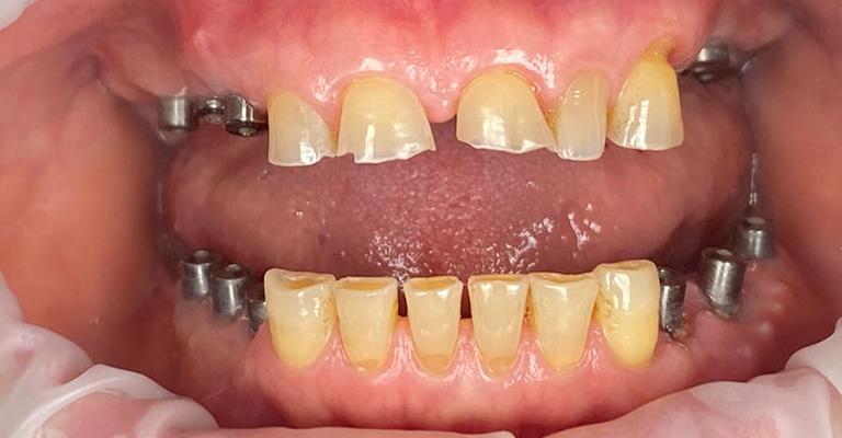 This image shows a close-up of upper and lower gums with multiple visible dental implants—metal posts embedded in areas where teeth are missing. The remaining natural teeth are noticeably yellowed and worn, contrasting with the sterile implant structures.