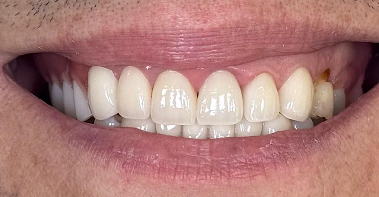 This close-up shows well-aligned upper and lower front teeth with generally healthy enamel. However, the upper right lateral incisor (from the viewer’s perspective) displays noticeable brown discoloration, possibly from staining or early decay.