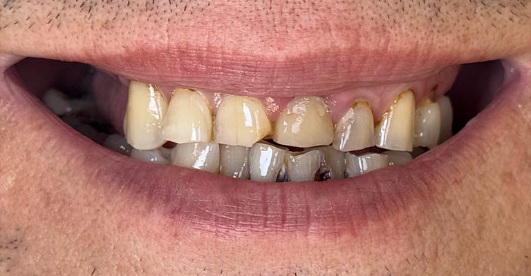 This image presents a close-up of upper and lower front teeth with advanced discoloration and brown staining—most prominent near the gum line. Several teeth exhibit structural damage, such as erosion and chipping, with visible gum recession exposing tooth roots.