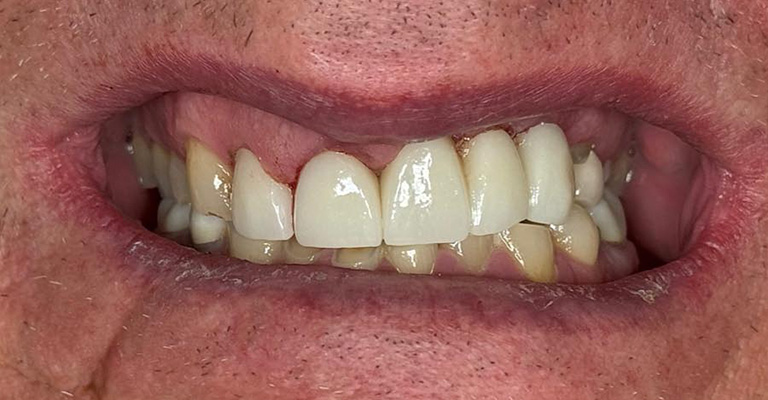 This close-up image highlights upper front teeth that have been restored with crowns or veneers. The restorations are bright and uniform, contrasting with the lower teeth, which have a yellowish tint and mild surface wear.
