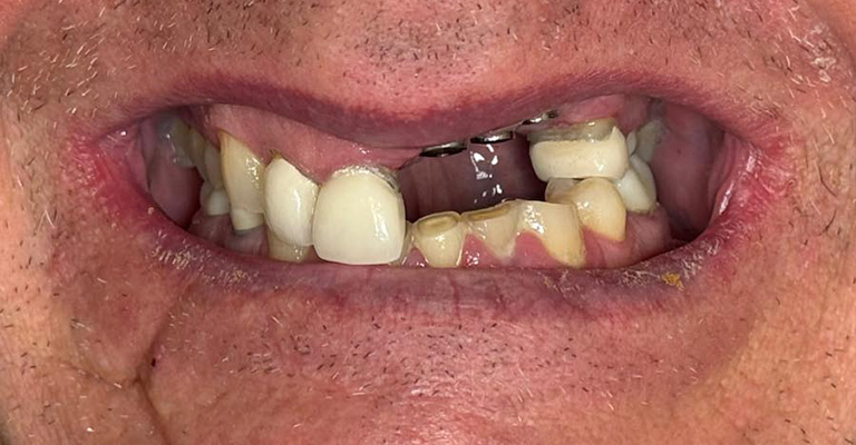 Close-up of a mouth showing missing teeth, misalignment, and visible decay. A partial denture or bridge is present on the upper row, and inflamed gums with plaque buildup suggest advanced dental issues requiring clinical intervention.