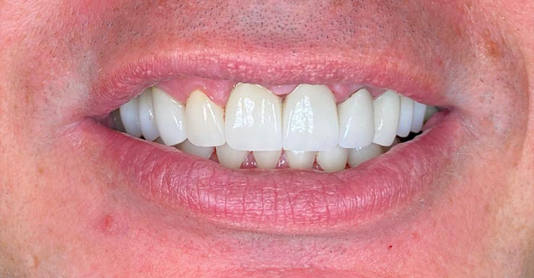 This image presents a close-up of upper and lower front teeth with healthy enamel and clean surfaces. The teeth are well-aligned, free from visible stains, decay, or restorations.