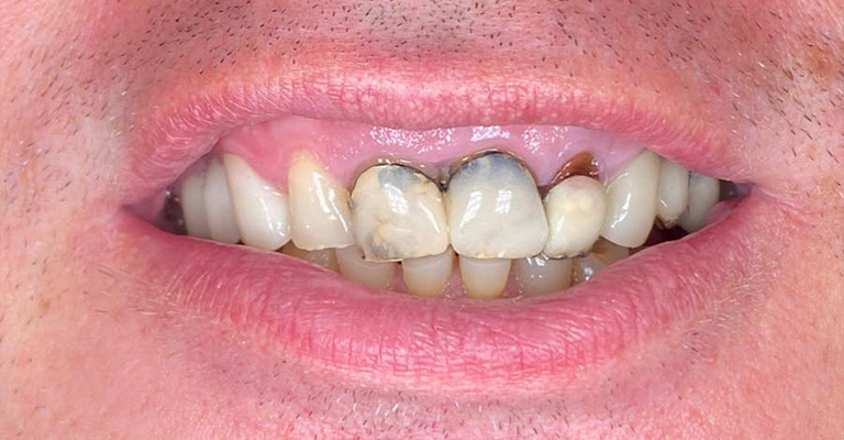 This image depicts severe dental decay affecting the upper and lower front teeth. Prominent dark cavities and structural breakdown are evident, especially on the two central incisors, which show advanced erosion and discoloration.