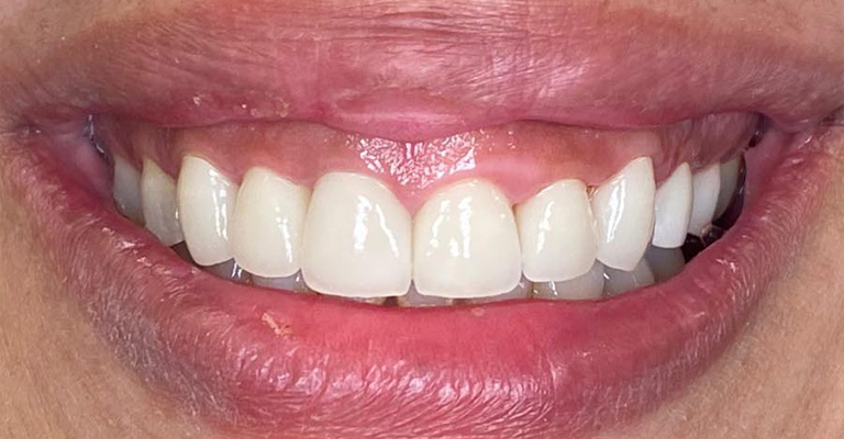 This close-up shows well-aligned upper and lower front teeth with healthy, pink gums and no visible signs of decay, erosion, or restoration. The natural enamel is intact and evenly colored, suggesting excellent oral hygiene.
