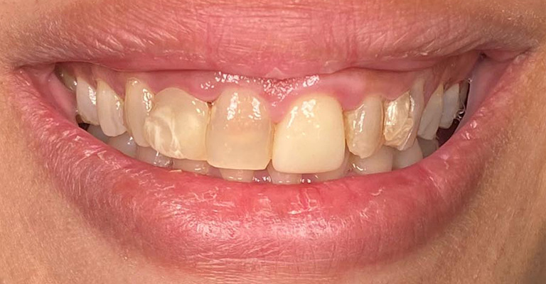 This close-up image reveals multiple dental restorations, likely crowns or veneers, applied to the upper front teeth. The restorations show a bright, uniform tone and smoother surface texture compared to the natural lower teeth, which exhibit mild staining and wear.