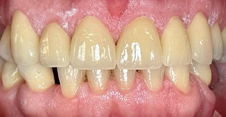 Close-up of upper and lower teeth showing slight overbite, visible gaps in the lower arch, and well-preserved gum health. The image highlights potential orthodontic needs while retaining a baseline of overall dental stability.
