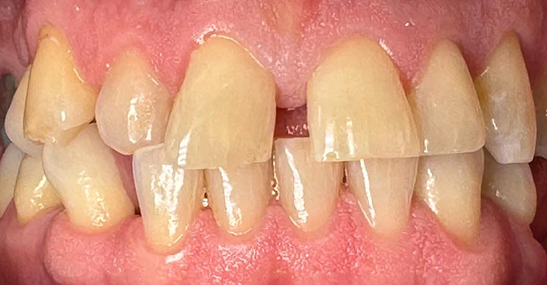 Close-up of crowded lower teeth with overlapping incisors and visible misalignment. Gums appear healthy, making this suitable for illustrating orthodontic needs such as braces or aligners.