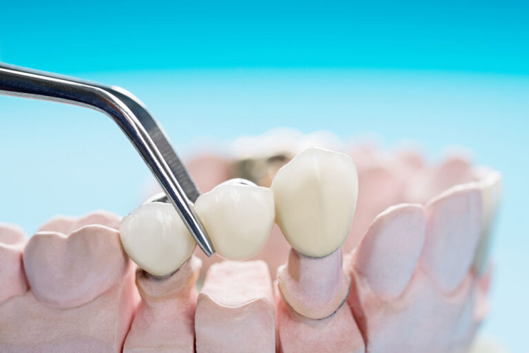 Dental Crowns and Bridges in Waltham: How Restorative Dentistry Protects Your Bite