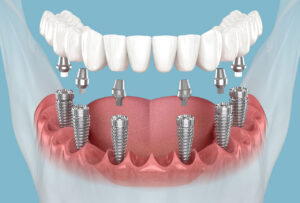 All-on-X Implants in Waltham, MA, at Koko Dental Care