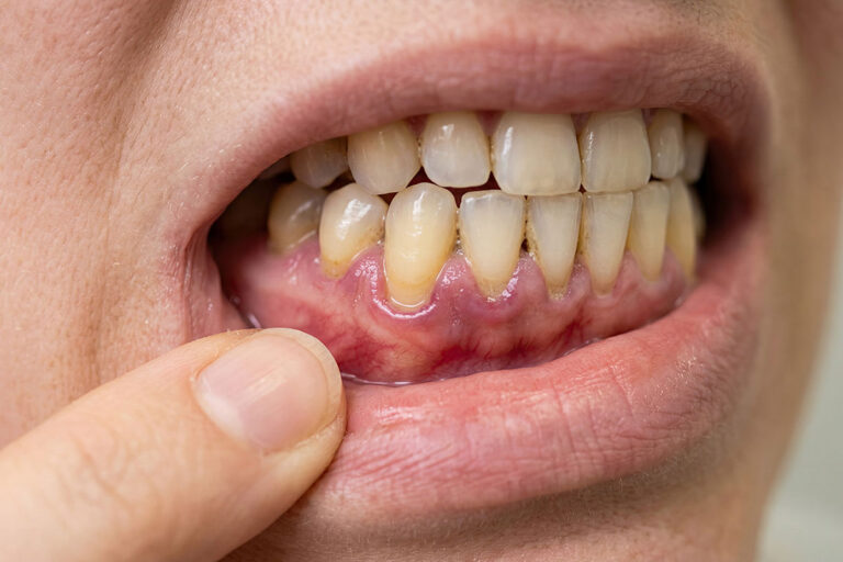 Periodontal Disease Treatment in Waltham, MA: Protecting the Foundation of Your Smile