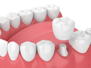 Dental Crowns and Bridges in Waltham, MA, at Koko Dental Care