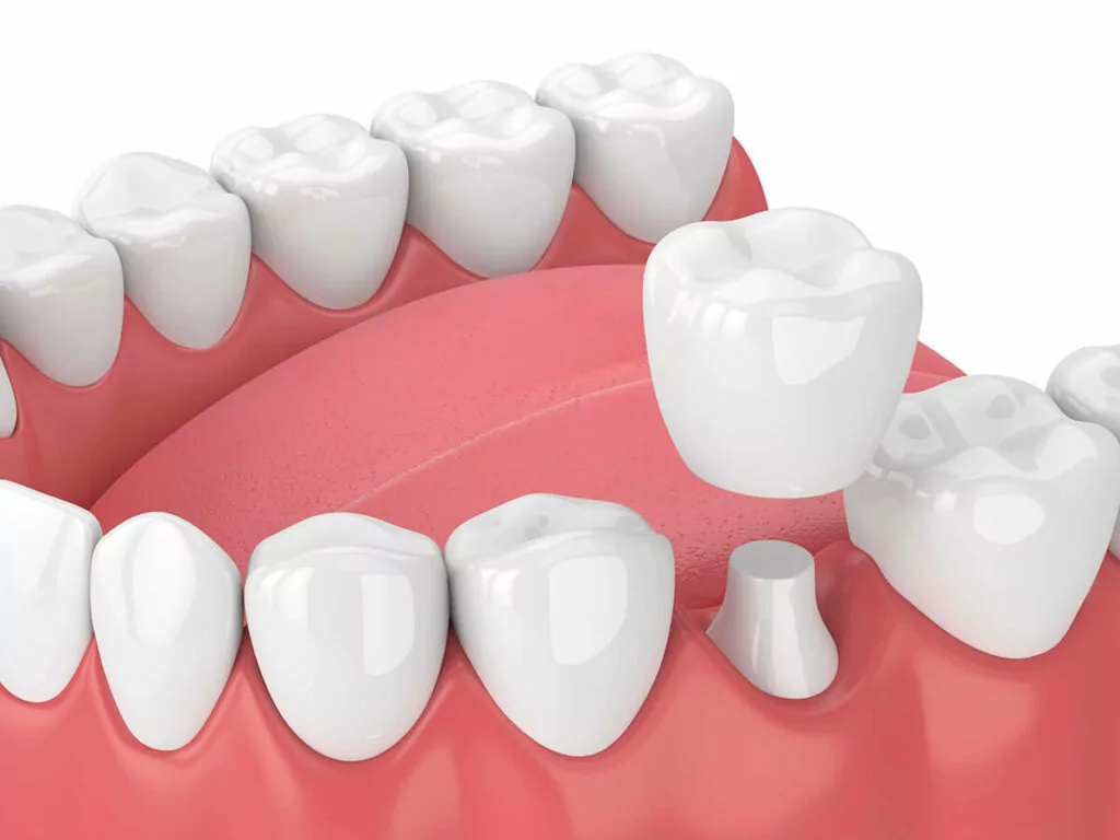 3D illustration of a lower jaw with dental crowns and a bridge, depicting a dental restoration process with one tooth prepared for crown placement, set against a white and pink background.