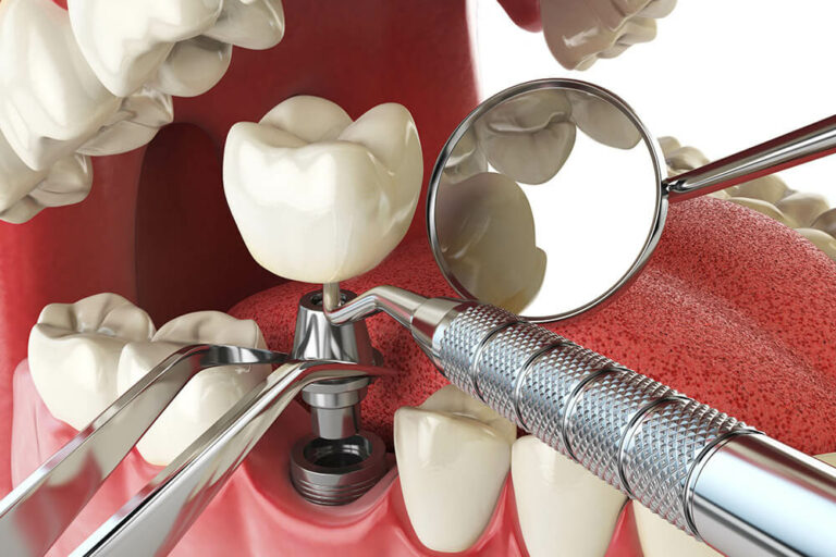 A close-up of a dental implant procedure being performed with various tools.