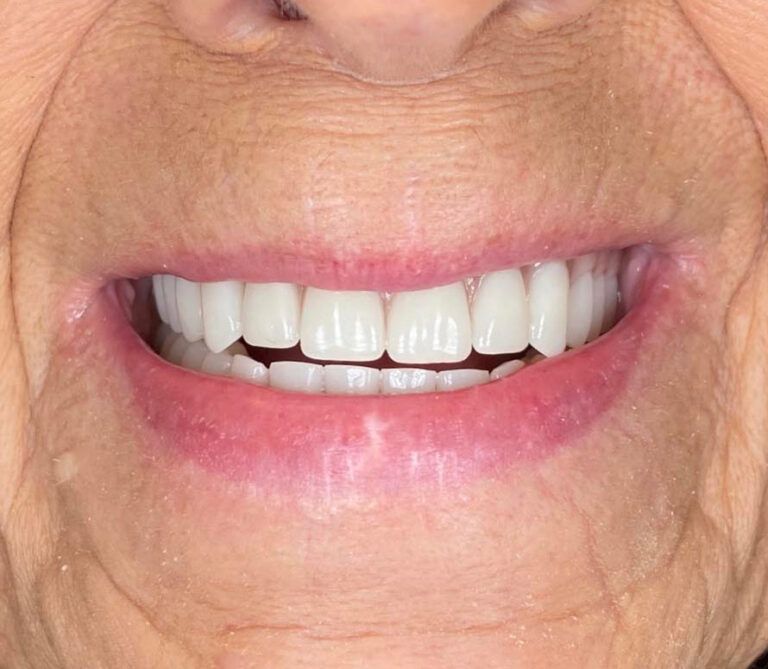 Close-up of a mouth with artificial teeth that are evenly spaced, bright white, and uniform in shape. Wrinkles around the lips suggest aging, highlighting the cosmetic impact of dental prosthetics.