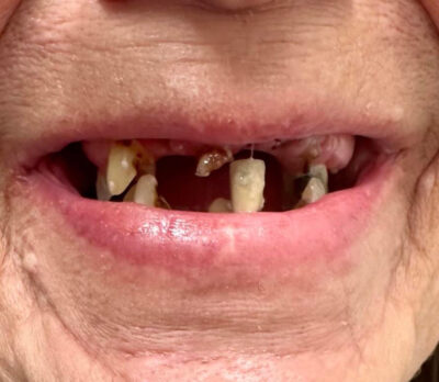 Close-up of a mouth showing multiple missing and decayed teeth, with remaining teeth discolored and damaged. The image reflects severe oral health deterioration, relevant for illustrating the need for dental intervention.