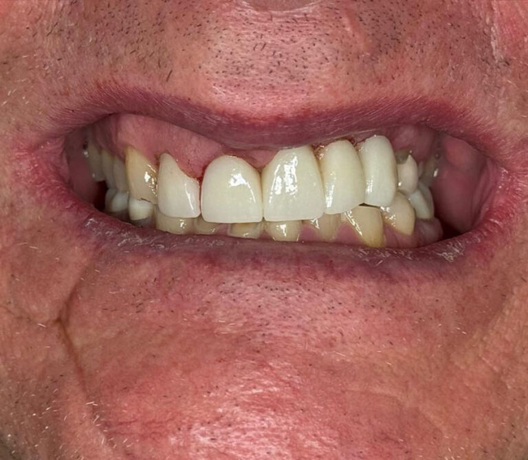 Close-up of a mouth showing upper front teeth with crowns or veneers that appear whiter and more uniform than adjacent natural teeth. Some natural teeth show discoloration and wear, with slightly recessed gums visible.