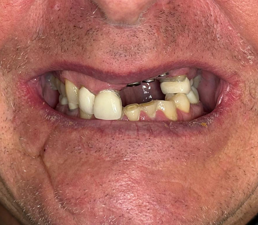 Close-up of a mouth showing missing teeth, visible crowns, discoloration, and a metal dental appliance in the upper jaw. The image illustrates complex oral health issues, including decay and misalignment, relevant for prosthodontic evaluation.