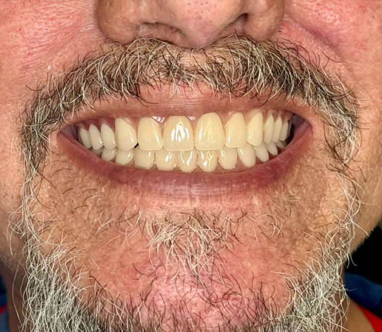 Close-up of a smiling mouth framed by a gray-and-white mustache and goatee, showing uniform artificial teeth. The image suggests dentures or veneers, highlighting the outcome of restorative dental work.