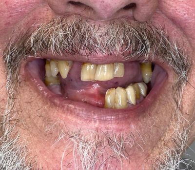 Close-up of a mouth showing multiple missing teeth and yellowed, worn remaining teeth with visible gum inflammation. The image reflects advanced dental issues, useful for illustrating oral health deterioration or treatment planning.