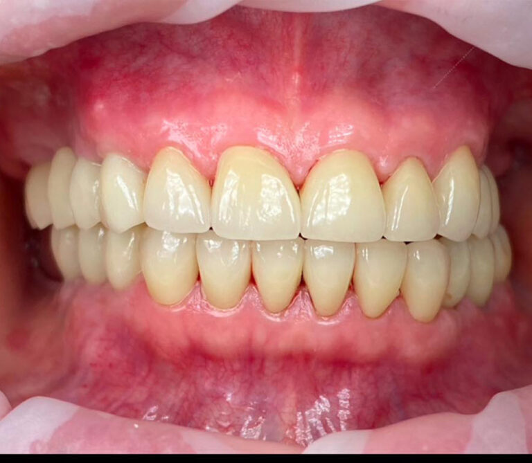 Close-up of a mouth with visible upper and lower dental prosthetics, showing evenly shaped and colored teeth. Healthy gums frame the restorations, highlighting the results of cosmetic or restorative dental work.