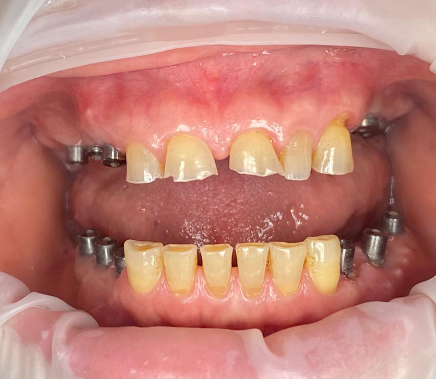 Close-up of a mouth with visible metal implant abutments in both jaws, surrounded by worn and discolored natural teeth. The image highlights oral conditions prior to prosthetic placement, useful for restorative dental planning.